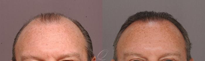 FUT Case 1001515 Before & After Front | Rochester, Buffalo, & Syracuse, NY | Quatela Center for Hair Restoration