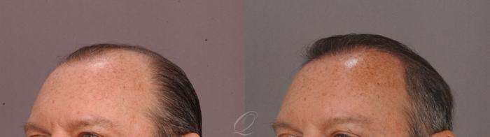 FUT Case 1001515 Before & After Left Oblique | Rochester, Buffalo, & Syracuse, NY | Quatela Center for Hair Restoration