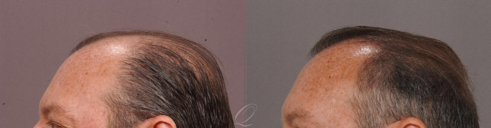 FUT Case 1001515 Before & After Left Side | Rochester, Buffalo, & Syracuse, NY | Quatela Center for Hair Restoration