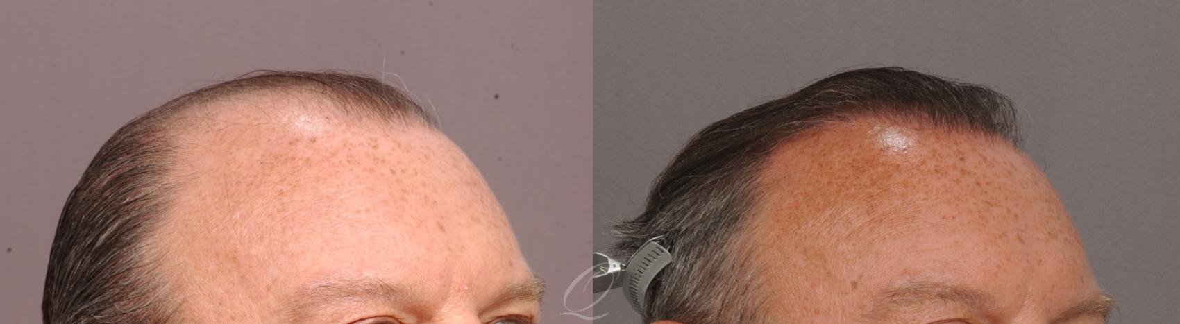 FUT Case 1001515 Before & After Right Oblique | Rochester, Buffalo, & Syracuse, NY | Quatela Center for Hair Restoration