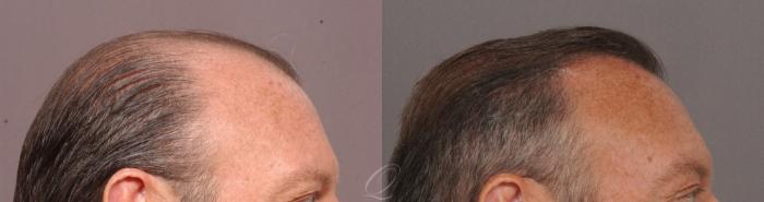 FUT Case 1001515 Before & After Right Side | Rochester, Buffalo, & Syracuse, NY | Quatela Center for Hair Restoration