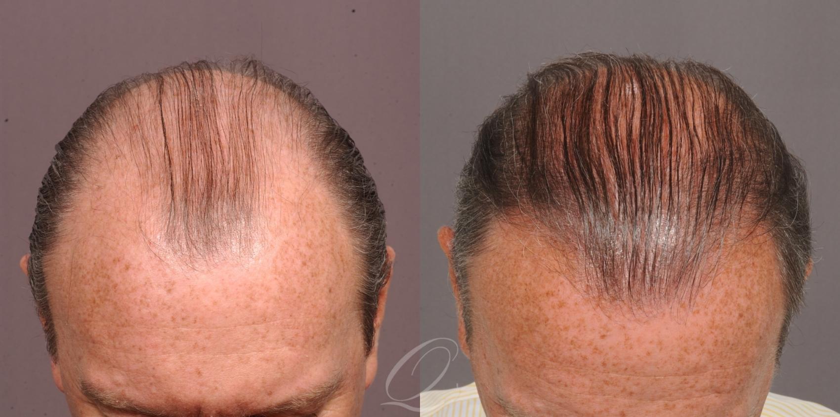 FUT Case 1001515 Before & After Top Down | Rochester, Buffalo, & Syracuse, NY | Quatela Center for Hair Restoration