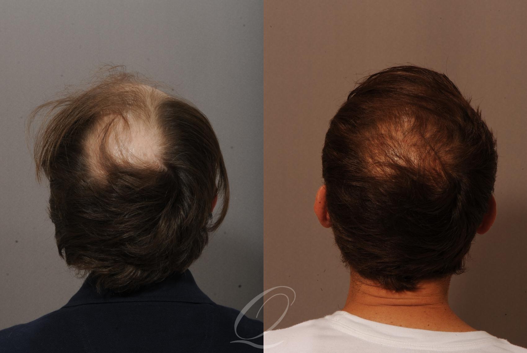 FUT Case 1001518 Before & After Back | Rochester, Buffalo, & Syracuse, NY | Quatela Center for Hair Restoration