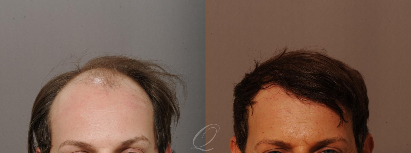 FUT Case 1001518 Before & After Front | Rochester, Buffalo, & Syracuse, NY | Quatela Center for Hair Restoration