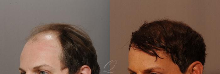 FUT Case 1001518 Before & After Left Oblique | Rochester, Buffalo, & Syracuse, NY | Quatela Center for Hair Restoration