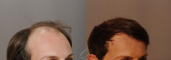 FUT Case 1001518 Before & After Right Oblique | Rochester, Buffalo, & Syracuse, NY | Quatela Center for Hair Restoration