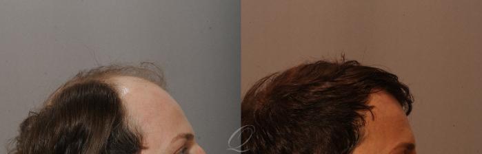 FUT Case 1001518 Before & After Right Side | Rochester, Buffalo, & Syracuse, NY | Quatela Center for Hair Restoration