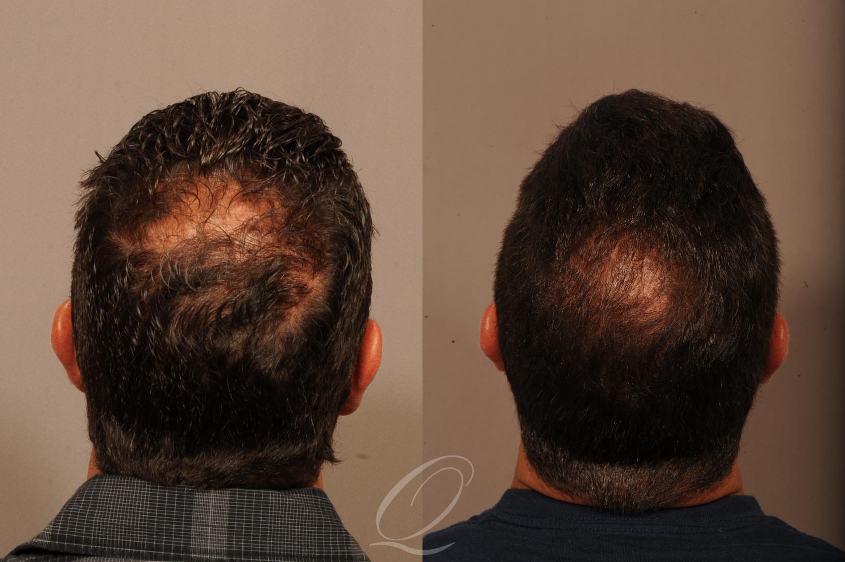 Male Crown Hair Restoration Case 1001519 Before & After Back | Serving Rochester, Syracuse & Buffalo, NY | Quatela Center for Plastic Surgery