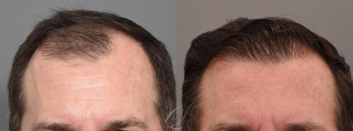 FUT Case 1001572 Before & After Front | Rochester, Buffalo, & Syracuse, NY | Quatela Center for Hair Restoration