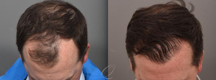 FUT Case 1001572 Before & After Head down | Serving Rochester, Syracuse & Buffalo, NY | Quatela Center for Plastic Surgery