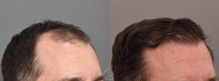 FUT Case 1001572 Before & After Right Oblique | Rochester, Buffalo, & Syracuse, NY | Quatela Center for Hair Restoration