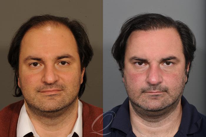 Before & After Male Hairline and Central Density Hair Restoration Case 1001573 Front View in Rochester, Buffalo, & Syracuse, NY