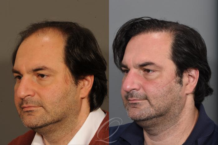 Male Hairline and Central Density Hair Restoration Case 1001573 Before & After Left Oblique | Serving Rochester, Syracuse & Buffalo, NY | Quatela Center for Plastic Surgery