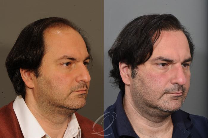 Male Hairline and Central Density Hair Restoration Case 1001573 Before & After Right Oblique | Serving Rochester, Syracuse & Buffalo, NY | Quatela Center for Plastic Surgery