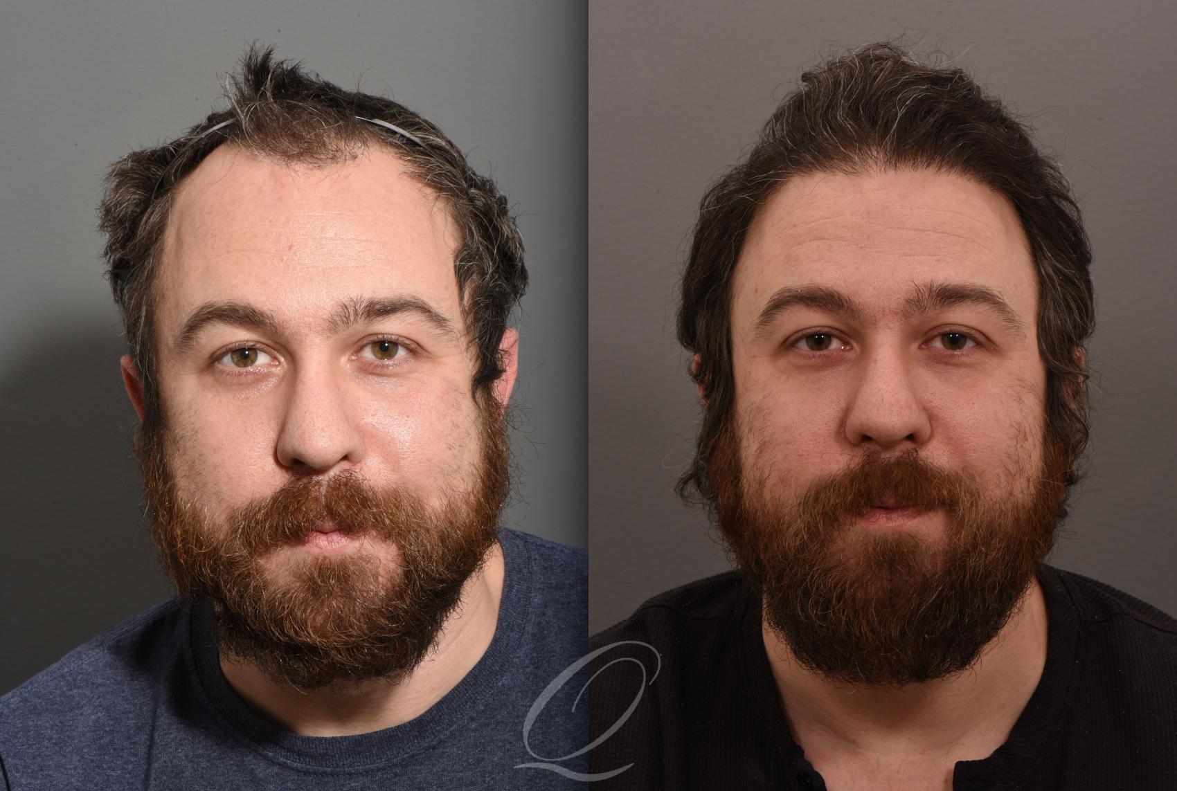 FUT Case 1001574 Before & After Front | Rochester, Buffalo, & Syracuse, NY | Quatela Center for Hair Restoration
