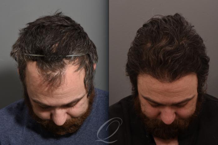 Male Hairline and Central Density Hair Restoration Case 1001574 Before & After Head down | Rochester, Buffalo, & Syracuse, NY | Quatela Center for Hair Restoration