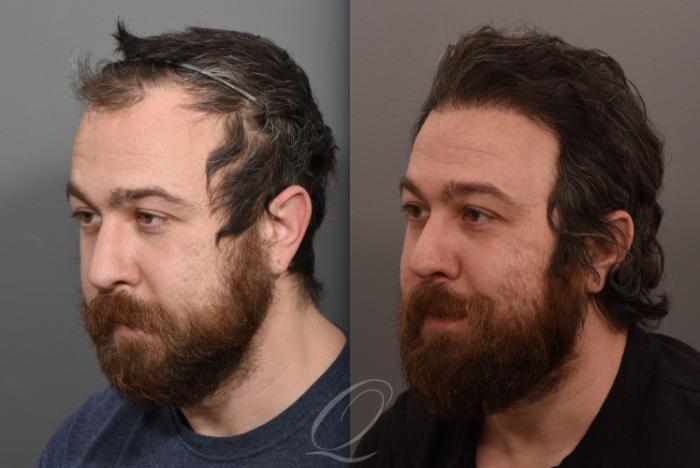 Male Hairline and Central Density Hair Restoration Case 1001574 Before & After Left Oblique | Rochester, Buffalo, & Syracuse, NY | Quatela Center for Hair Restoration