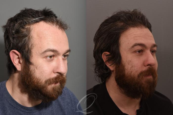 Male Hairline and Central Density Hair Restoration Case 1001574 Before & After Right Oblique | Rochester, Buffalo, & Syracuse, NY | Quatela Center for Hair Restoration