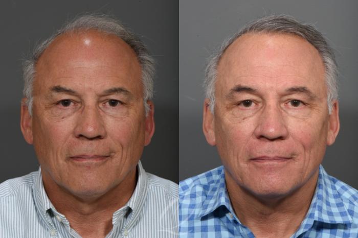 Male Hairline and Central Density Hair Restoration Case 1001575 Before & After Front | Rochester, Buffalo, & Syracuse, NY | Quatela Center for Hair Restoration