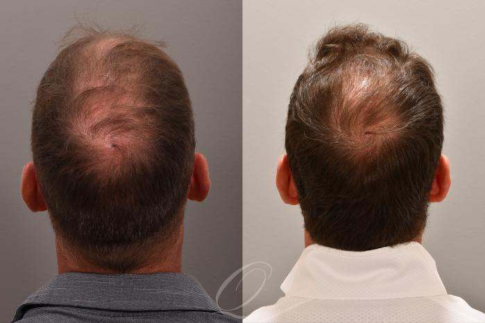 Male Crown Hair Restoration Case 1001578 Before & After Back | Serving Rochester, Syracuse & Buffalo, NY | Quatela Center for Plastic Surgery
