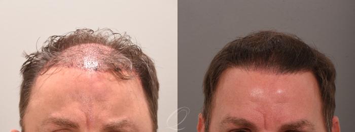 Before & After Male Crown Hair Restoration Case 1001578 Front View in Rochester, Buffalo, & Syracuse, NY