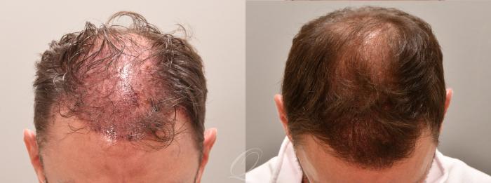 Before & After Male Crown Hair Restoration Case 1001578 Head down View in Rochester, Buffalo, & Syracuse, NY