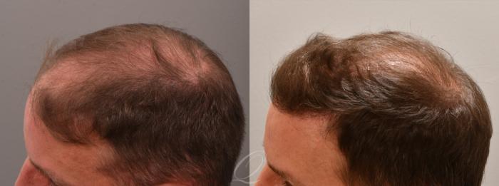 FUT Case 1001578 Before & After Left Side | Rochester, Buffalo, & Syracuse, NY | Quatela Center for Hair Restoration