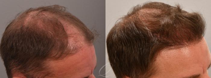 Male Hairline and Central Density Hair Restoration Case 1001578 Before & After Right Oblique | Rochester, Buffalo, & Syracuse, NY | Quatela Center for Hair Restoration