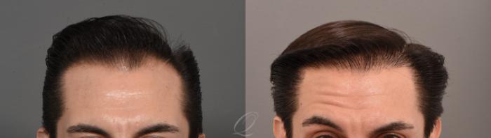 Before & After Male Hairline and Central Density Hair Restoration Case 1001579 Front View in Rochester, Buffalo, & Syracuse, NY
