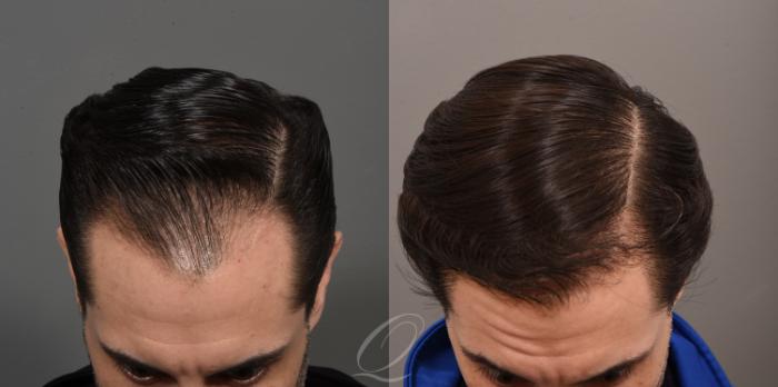 Before & After Male Hairline and Central Density Hair Restoration Case 1001579 Head down View in Rochester, Buffalo, & Syracuse, NY