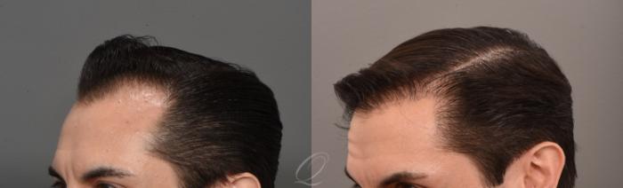 Before & After Male Hairline and Central Density Hair Restoration Case 1001579 Left Oblique View in Rochester, Buffalo, & Syracuse, NY