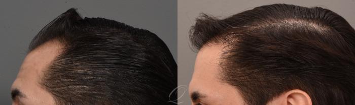 Before & After Male Hairline and Central Density Hair Restoration Case 1001579 Left Side View in Rochester, Buffalo, & Syracuse, NY
