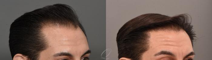Before & After Male Hairline and Central Density Hair Restoration Case 1001579 Right Oblique View in Rochester, Buffalo, & Syracuse, NY