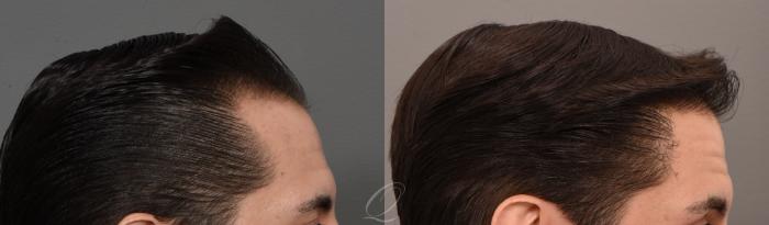 Before & After Male Hairline and Central Density Hair Restoration Case 1001579 Right Side View in Rochester, Buffalo, & Syracuse, NY