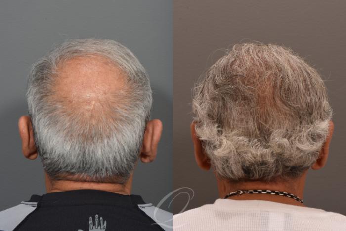 Male Crown Hair Restoration Case 1001580 Before & After Back | Serving Rochester, Syracuse & Buffalo, NY | Quatela Center for Plastic Surgery
