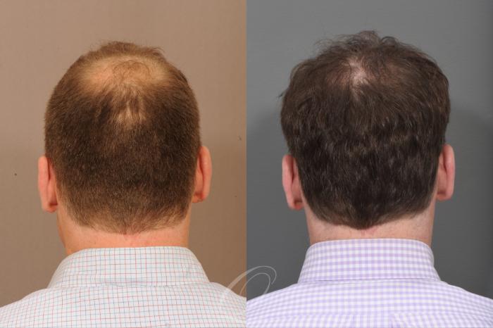 Before & After Male Crown Hair Restoration Case 1001581 Back View in Rochester, Buffalo, & Syracuse, NY