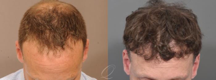 FUT Case 1001581 Before & After Front | Rochester, Buffalo, & Syracuse, NY | Quatela Center for Hair Restoration
