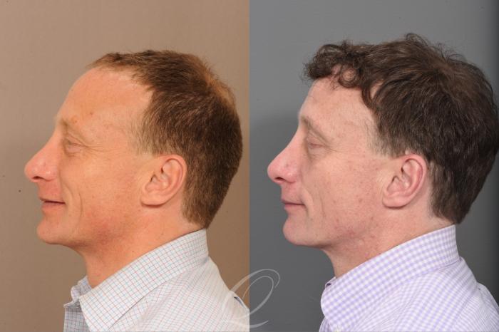 Before & After Male Crown Hair Restoration Case 1001581 Left Side View in Rochester, Buffalo, & Syracuse, NY