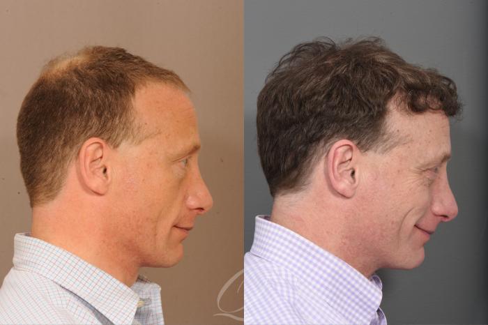 Before & After Male Crown Hair Restoration Case 1001581 Right Side View in Rochester, Buffalo, & Syracuse, NY
