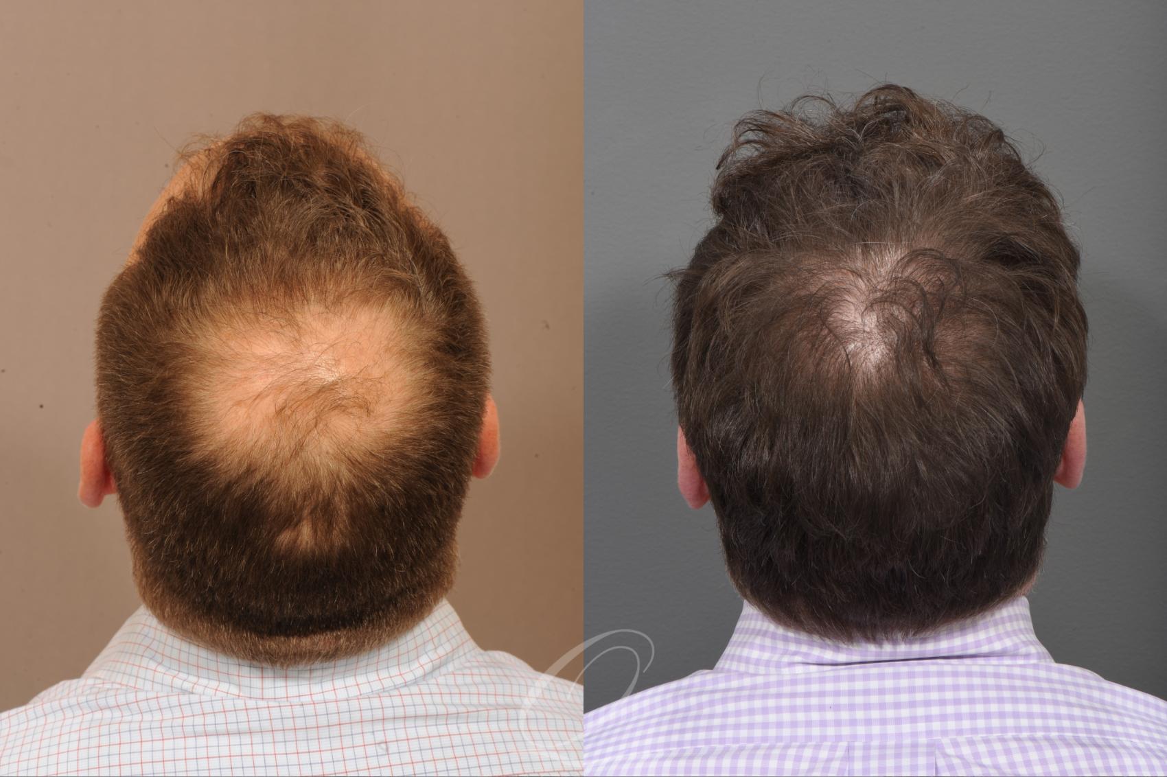 Hair Transplant Results| Crown