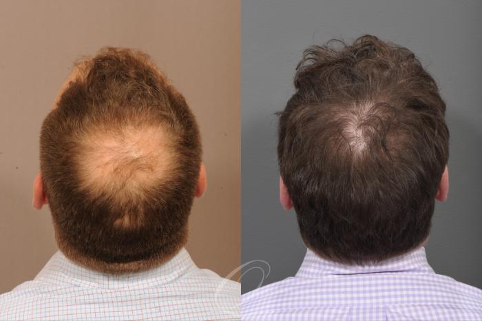 Male Crown Hair Restoration Case 1001581 Before & After Top View | Serving Rochester, Syracuse & Buffalo, NY | Quatela Center for Plastic Surgery
