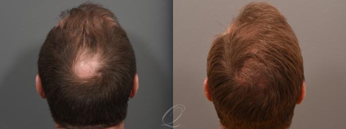 Male Crown Hair Restoration Case 1001684 Before & After Back | Serving Rochester, Syracuse & Buffalo, NY | Quatela Center for Plastic Surgery