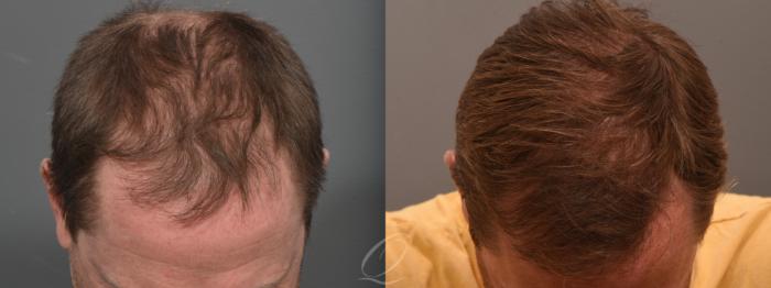 Male Crown Hair Restoration Case 1001684 Before & After Front | Serving Rochester, Syracuse & Buffalo, NY | Quatela Center for Plastic Surgery