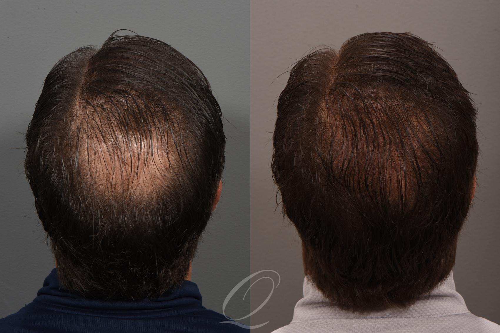 Male Crown Hair Restoration Case 1001685 Before & After Back | Serving Rochester, Syracuse & Buffalo, NY | Quatela Center for Plastic Surgery