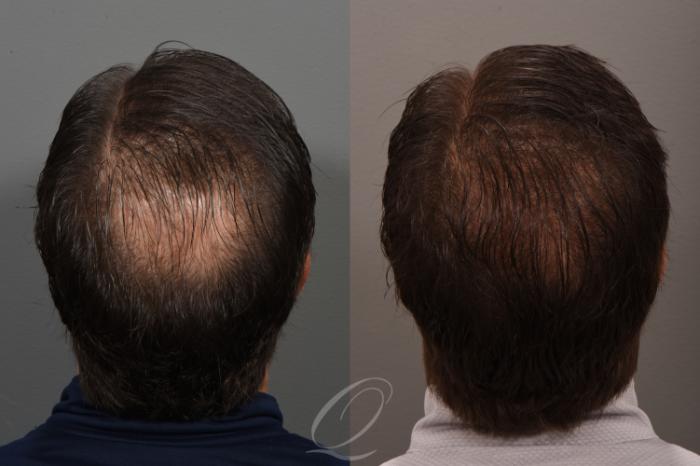 Male Crown Hair Restoration Case 1001685 Before & After Back | Rochester, Buffalo, & Syracuse, NY | Quatela Center for Hair Restoration