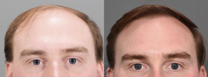 FUT Case 1001696 Before & After Front | Serving Rochester, Syracuse & Buffalo, NY | Quatela Center for Plastic Surgery