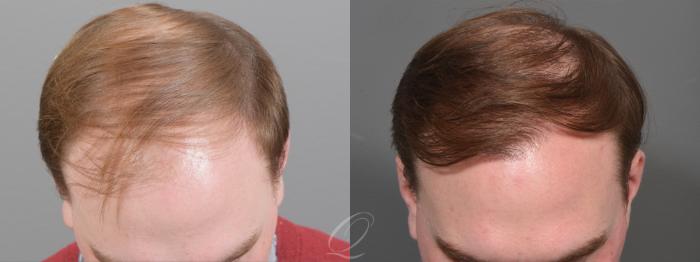 FUT Case 1001696 Before & After Top View | Serving Rochester, Syracuse & Buffalo, NY | Quatela Center for Plastic Surgery