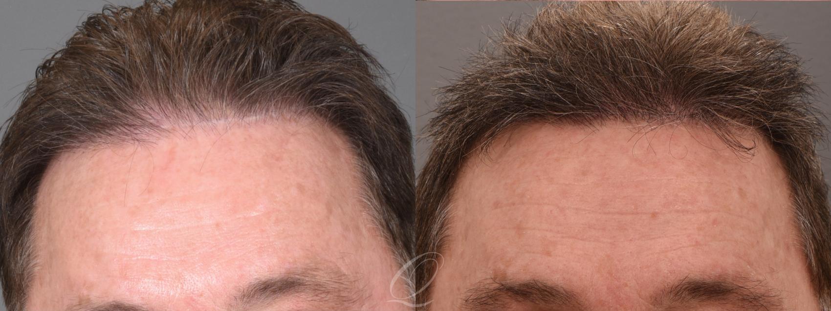FUT Case 1001697 Before & After Front | Serving Rochester, Syracuse & Buffalo, NY | Quatela Center for Plastic Surgery