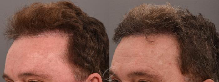 FUT Case 1001697 Before & After Left Oblique | Serving Rochester, Syracuse & Buffalo, NY | Quatela Center for Plastic Surgery