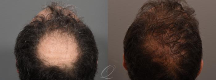 Male Hairline and Central Density Hair Restoration Case 1001698 Before & After Back | Serving Rochester, Syracuse & Buffalo, NY | Quatela Center for Plastic Surgery